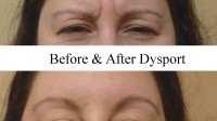 Botox between the eyebrows by Dr. David This patient is making the same face in both pictures