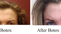 Botox between the eyebrows by Dr. Dave David. Patient is making the same face in both pictures.