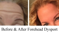 Botox of the forehead by Dr. Dave David. This patient is making the same face in both pictures