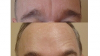 Dysport between the eyebrows by Dr. Dave David. This patient is making the same face in both pictures