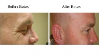 Botox of crows' feet by Dr. Dave This patient is making the same face in both pictures.