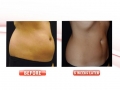 CoolSculpting 6 weeks later