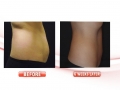 CoolSculpting 6 weeks later
