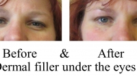 Fillers under Eyes (IMMEDIATELY after procedure). As you can see, the needle marks from the procedure are present in the picture. They disappeared within an hour.