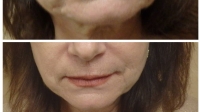 Facial Fillers by Dr. Dave David: "Marionette Lines"