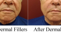 Facial Fillers by Dr. Dave David