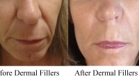 Restylane for facial lines and slight lip enhancement by Dr. Dave David