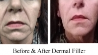 Facial Fillers by Dr. Dave David: Front View of After Pic