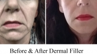 Facial Fillers by Dr. Dave David: Front View of After Pic