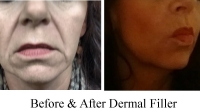 Facial Fillers by Dr. Dave David: Oblique View