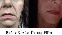 Facial Fillers by Dr. Dave David: Oblique View