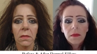 Full Face View of fillers of Naso Labial Folds and Oral Commissures by Dr. Dave David