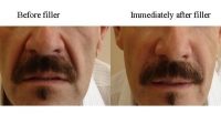 Facial fillers in a man by Dr. David