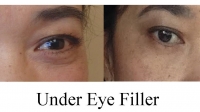 Filling under the eyes with Restylane by Dr. Dave David