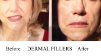 Dermal Fillers applied to a woman's face by Dr. David