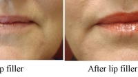 Filler in lips by Dr David
