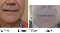 Restylane for the "smile lines" ("Naso labial folds") by Dr. Dave David