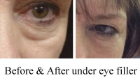 Restylane for "dark circles" under the eye by Dr. Dave David