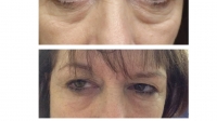 Restylane for "dark circles" under the eyes ("tear troughs") by Dr. Dave David