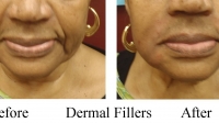 Facial Fillers by Dr. Dave David