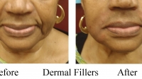Facial Fillers by Dr. Dave David