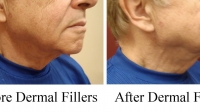 Facial Fillers of man by Dr. David (side view)