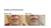 Pt asking for very subtle filling of lips