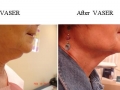 VASER Lipo Neck by Dr. Dave David