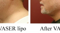 pt 1: Vaser of male neck by Dr. David--side view)