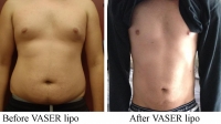pt 10: VASER by Dr. David of male chest, abdomen and love handles