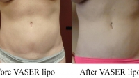 pt 100: VASER of woman's abdomen by Dr. David
