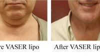 pt 101: VASER of male neck by Dr. David