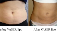pt 102: VASER of woman's abdomen by Dr. David