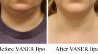 pt 104: VASER of female neck by Dr. David