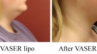 pt 105: VASER of female neck by Dr. David