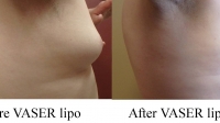 pt 106: VASER of mild gynecomastia by Dr. David