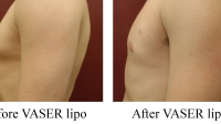 pt 109: VASER of male chest by Dr. David