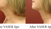 pt 11: VASER of woman's neck by Dr. David