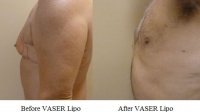 pt 111: VASER of male chest by Dr. David