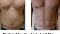 pt 116: VASER of chest, abdomen and flanks in a man (by Dr. David)