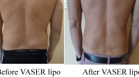 pt 117: VASER of man's flanks/love handles by Dr. David