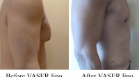 pt 118: Chest VASER by Dr. David