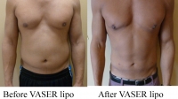 pt 119: VASER of male chest, abdomen and love handles by Dr. David