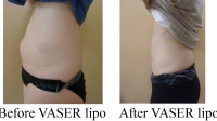 pt 123: VASER of abdomen by Dr. David