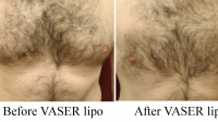 pt 124: VASER of male chest by Dr. David