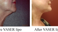 pt 126 :VASER of neck by Dr.David of woman with irregularity of contour of her neck, more so than fat. The VASER was able to make her nice and smooth