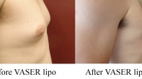 pt 127: VASER of mild gynecomastia by Dr. David