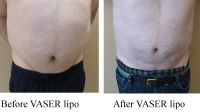 pt 128: VASER of male abdomen by Dr. David