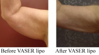 pt 130: VASER of female upper arms by Dr. David (soon after VASER--before final result)