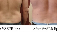 pt 133: VASER of male love handles by Dr. David (preliminary result)